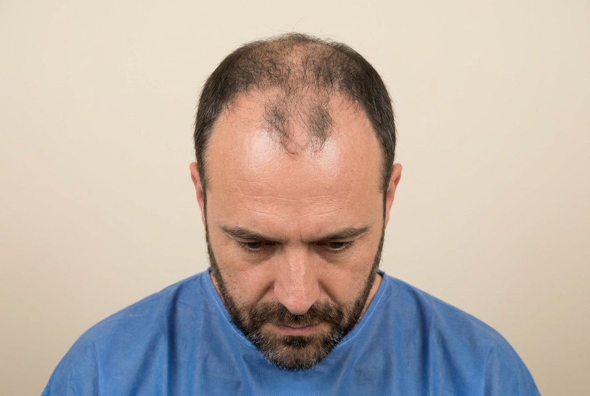 Hairline Restoration — Men — before