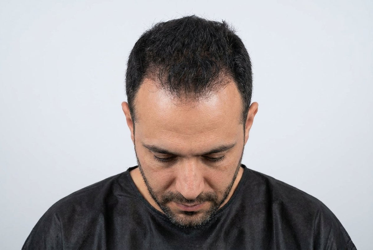 Temple Regrowth — Men — before