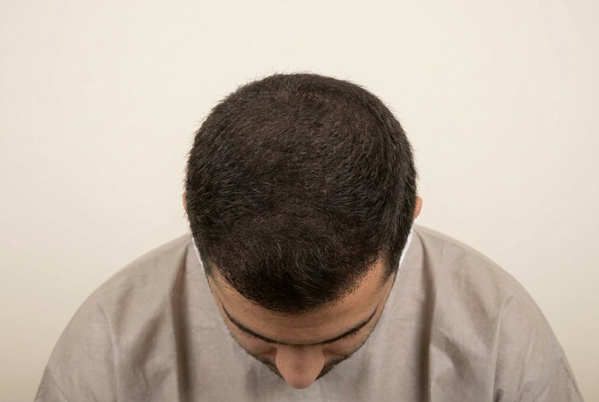 Crown density — after