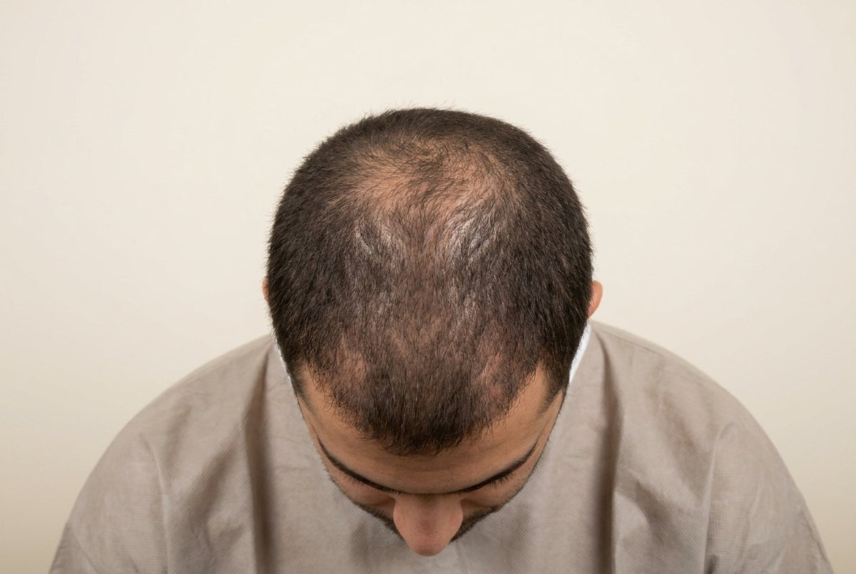 Crown density — before