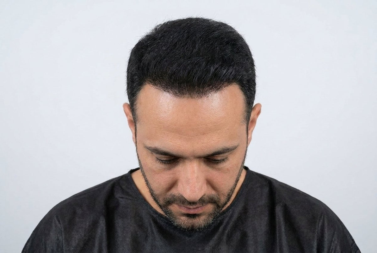 Temple Regrowth — Men — after
