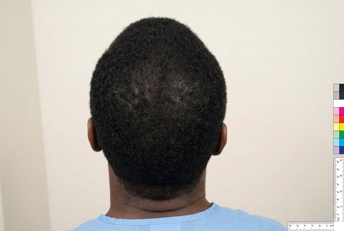Crown Coverage — Men — after