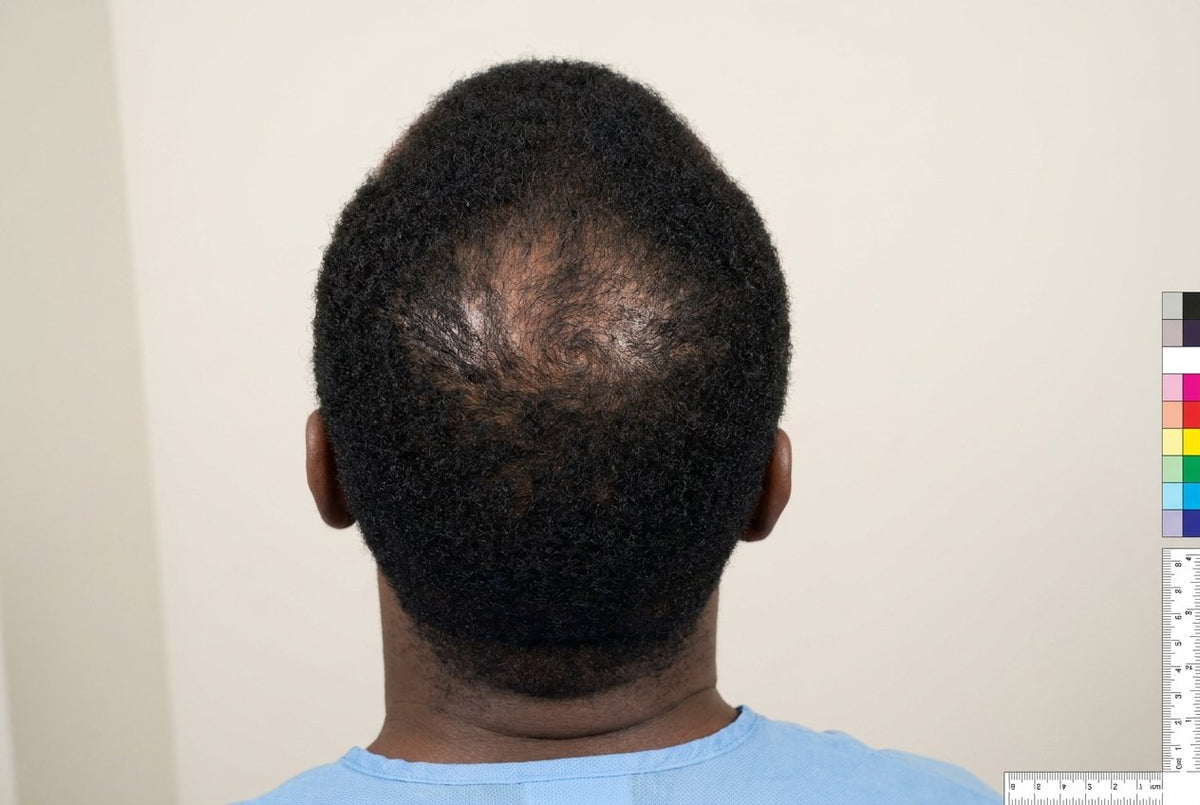 Crown Coverage — Men — before